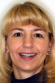Behandlung mit Invisalign