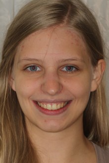 Festsitzende Zahnspange